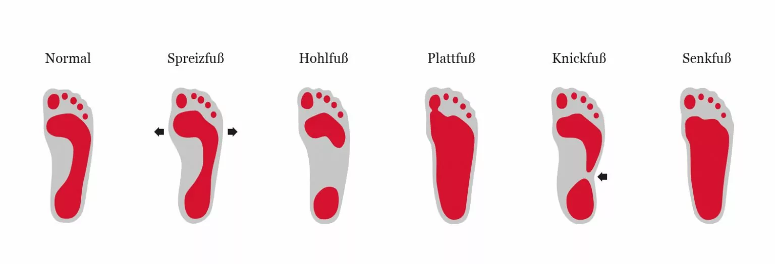 Die häufigsten Fußfehlstellungen verständlich erklär