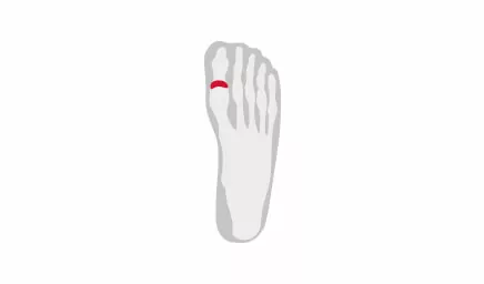 Hallux Rigidus (stiff toe) - a simple explanation